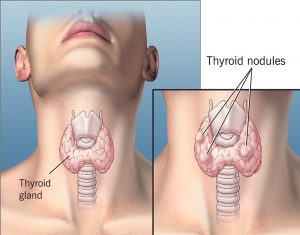 Thyroid Colloid Cyst