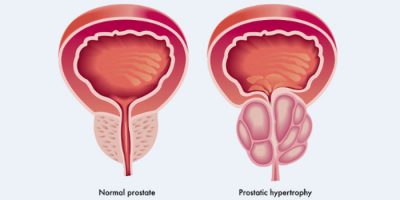 prostate-enlargement-1